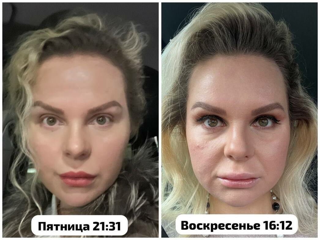 Алиса Вокс показала лицо с отеком Квинке