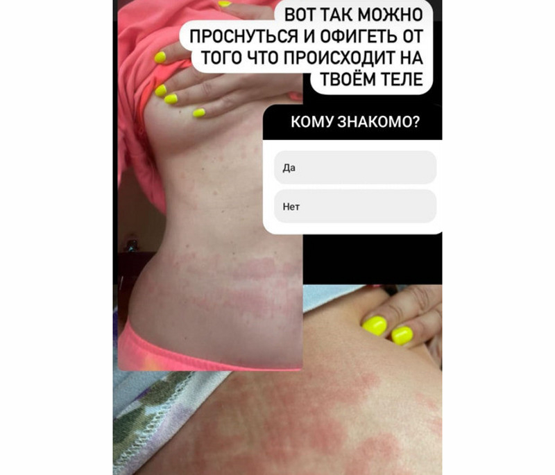 Знаменитость продемонстрировала красные пятна на своей коже