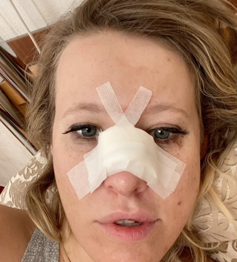Собчак сломала нос и попала в больницу